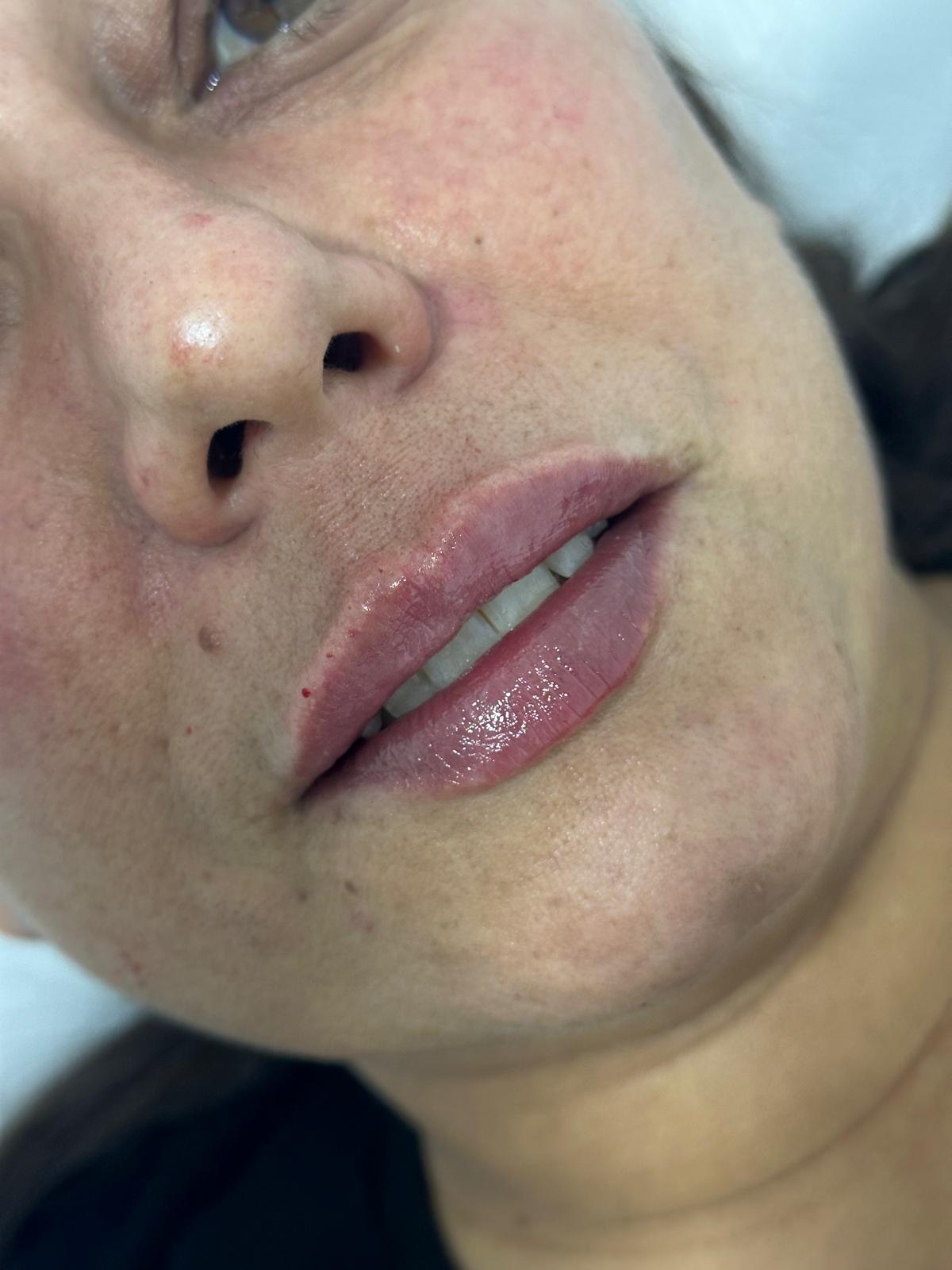 Definición de contorno y volumen labial · Después