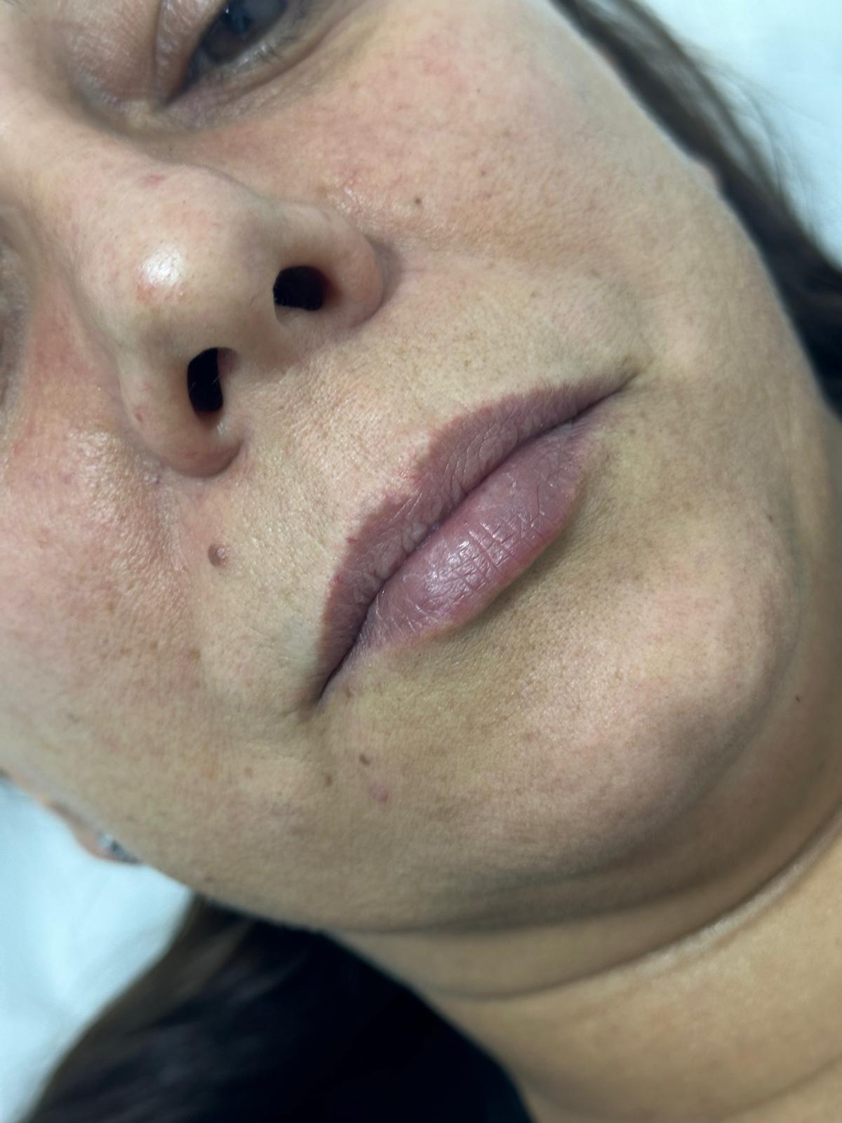 Definición de contorno y volumen labial · Antes
