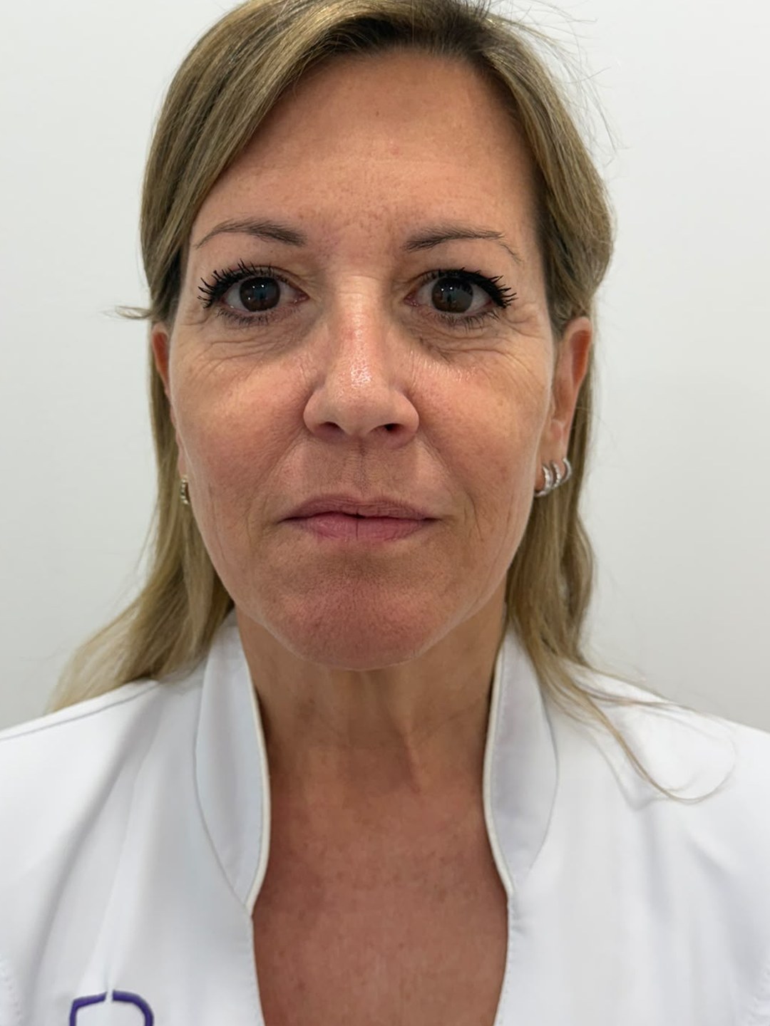 Bioestimulación con enzimas recombinantes · Después